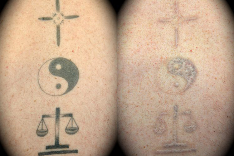 tattoo removal before and after los angelesTikTok Search