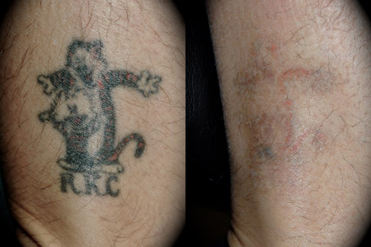 Los AngelesLaser Tattoo Removal BeforeAfter Photos  YouTube