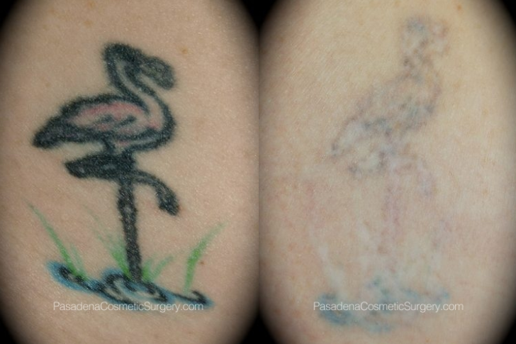 Laser Tattoo Removal in Nepal | Kathmandu Clinic of Cosmetic Surgery