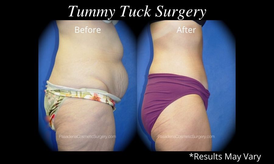 Why Do I Have A Full Upper Stomach After My Tummy Tuck? - Plastic Surgeon