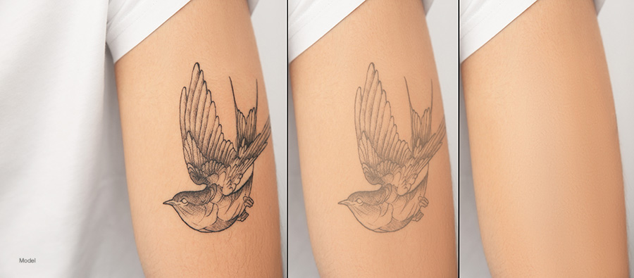 Three photos of a woman's arm with a bird tattoo at different stages of laser tattoo removal.