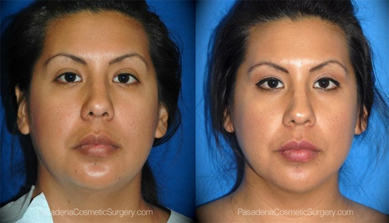 Before and after photo of a female Pasadena Cosmetic Surgery Smart Lipo® patient.