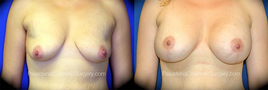 Before and after photos of augmentation with a lift - Pasadena Plastic Surgery.
