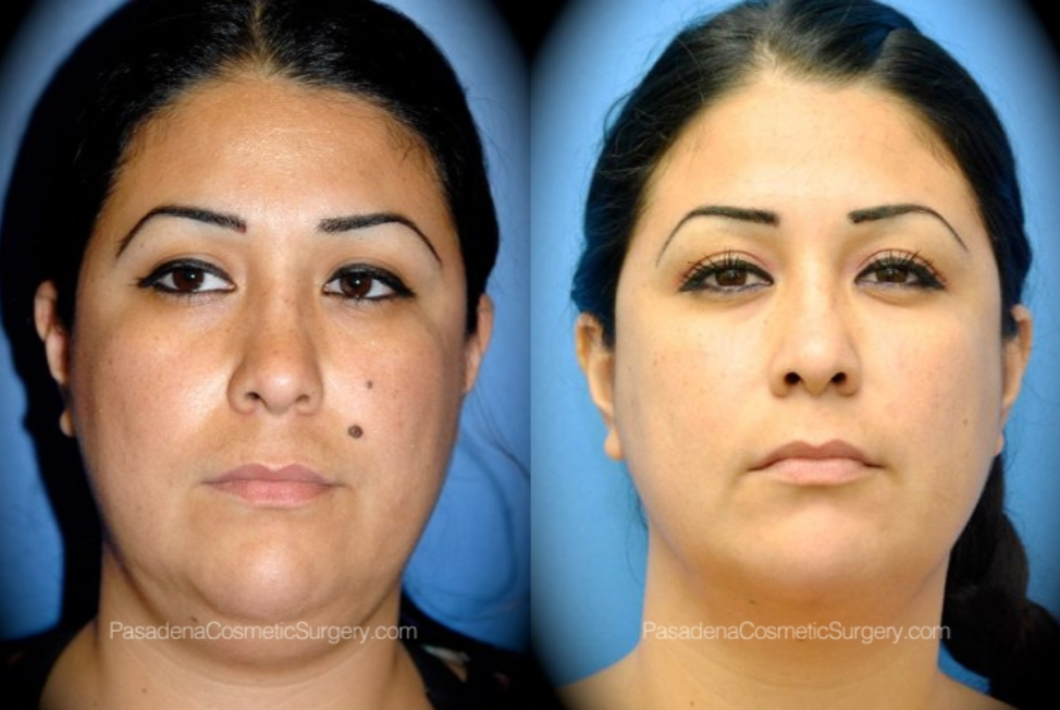 Pasadena Cosmetic Surgery - Smartlipo® before and after photo